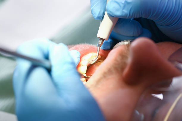 Best Emergency Dental Extractions in Lake Winnebago, MO